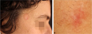 (A), Aspecto clínico da lesão residual após três semanas de uso de clobetasol sobre a lesão. (B), Aspecto à dermatoscopia de contato sem imersão após três semanas.