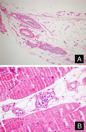 Células tumorais nos lúmens dos vasos no tecido adiposo subcutâneo (A: Hematoxilina & eosina, 100×) e tecido muscular (B: Hematoxilina & eosina, 400×).