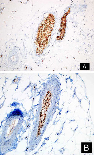 As células tumorais foram positivas para CD20 (A: DAB, 200×) e MUM‐1 (B: DAB, 200×).