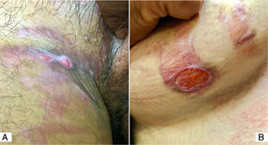 (A), Duas úlceras ovais superficiais sobre estrias na região inguinal. (B), Úlcera oval de cor vermelho‐vivo sobre ampla estria atrófica com telangiectasias, estendendo‐se da porção anterior até a inferior da mama. A paciente apresentava tinea na area em que usava os cremes contendo clobetasol.