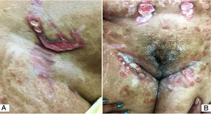 (A), Estrias múltiplas, largas, de cor vermelho‐vivo, ulceradas, no abdome. Úlceras ovais de aparência semelhante, bem como de orientação linear na região inguinal. Presença de tinea corporis generalizada modificada por esteroide (tinea incógnita). (B), Úlceras lineares de cor vermelho‐vivo, com bordas salientes hiperpigmentadas limitadas às estrias.