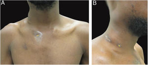 Aspecto clínico do paciente. (A−B) Dermatose localizada na face lateral direita da região cervical e torácica superior caracterizada por abcessos frios e indolores de até 5 cm de diâmetro, alguns com fistulização e úlceras.