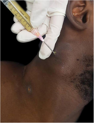 Coleta de material de abcesso cervical por punção com agulha grossa.