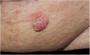 Placa verrucosas eritematosas com estruturas amareladas em região pubiana.