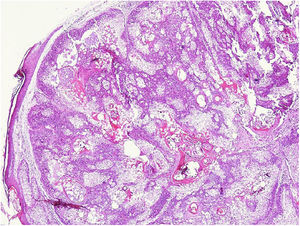 Visão panorâmica de proliferação lobular dérmica composta predominantemente de células sebáceas maduras (Hematoxilina & eosina, 40×).