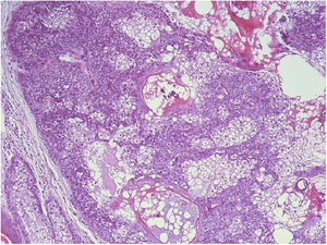 Detalhe da proliferação lobular com células multivacuolizadas no centro e células menores não vacuolizadas na periferia (Hematoxilina & eosina, 200×).