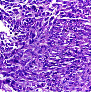 Neoplasia infiltrativa constituída por células epitelioides e fusiformes com citoplasma eosinofílico e núcleos irregulares com nucléolos evidentes (Hematoxilina & eosina, 400×).