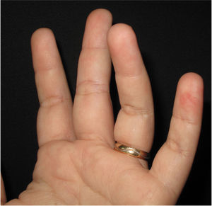 Máculas eritematosas nas polpas digitais dos terceiro, quarto e quinto quirodáctilos da mão esquerda.