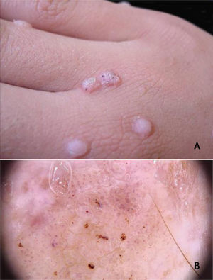 (A), Verruga vulgar, pápulas com superfície ceratósica, algumas com pontilhado escuro. (B), Verruga vulgar (dermatoscopia), vasos circundados por um halo branco e pontos hemorrágicos. Arquivo: Serviço de Dermatologia do HC‐UFMG/EBSERH.