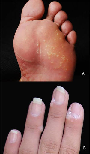 (A), Verruga plantar em mosaico. (B), Verruga periungueal. Arquivo: Serviço de Dermatologia do HC‐UFMG/EBSERH.