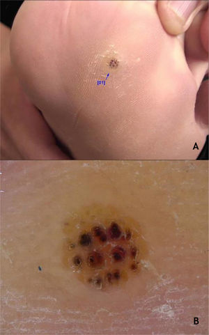 (A), Verruga plantar tipo mirmécia (assinalada). (B), Verruga plantar (dermatoscopia), pontos hemorrágicos sobre um fundo de cor amarelada com interrupção das linhas da pele. Arquivo: Serviço de Dermatologia do HC‐UFMG/EBSERH.