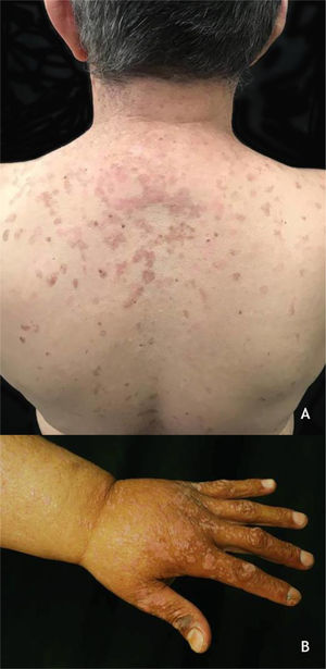 (A), Epidermodisplasia verruciforme, placas eritematosas e/ou acastanhadas que lembram lesões de pitiríase versicolor e ceratose seborreica no tronco. (B), Síndrome de WILD, numerosas pápulas eritematosas achatadas confluentes formando placas no dorso da mão e antebraço associadas à linfedema do membro superior. Arquivo: Serviço de Dermatologia do HC‐UFMG/EBSERH.