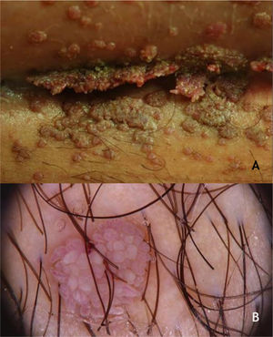 (A), Condiloma acuminado, pápulas e placas com aspecto vegetante, de coloração cor da pele, rósea e acastanhada, localizada na dobra suprapúbica. (B), Condiloma acuminado, dermatoscopia, vasos circundados por halo branco em projeções digitiformes. Arquivo: Serviço de Dermatologia do HC‐UFMG/EBSERH.