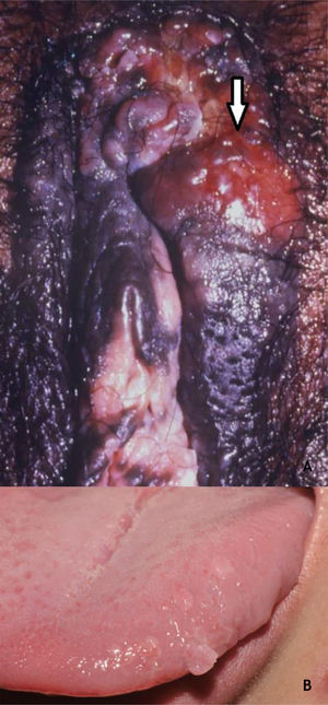 (A), Papulose bowenoide, múltiplas placas hiperpigmentadas na região genital feminina em paciente imunocompetente, com tumoração infiltrativa e erodida (assinalada). (B), Condilomas orais, pápulas achatadas e lesão pedunculada na borda lateral da língua. Arquivo A: Serviço de Dermatologia do HC‐UFMG/EBSERH. Arquivo B: Disciplina de Dermatologia, Faculdade de Medicina de Botucatu – Unesp.