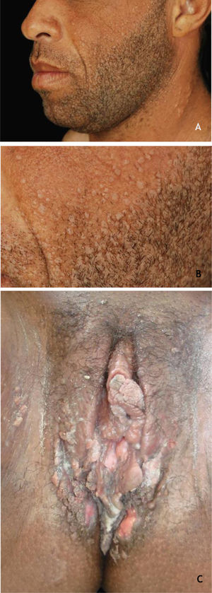 (A e B), Verrugas planas em paciente transplantado. (C), Condiloma acuminado em gestante HIV positiva, mostrando múltiplas pápulas e placas condilomatosas, algumas erosadas (secundária ao uso de medicação tópica) acometendo área extensa. Arquivo: HC‐UFMG.