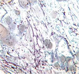 Numerosas hifas espessas (Gomori‐Grocott, 10×).