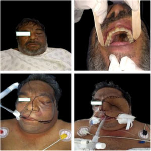 Quadro clínico de um paciente antes e depois de cirurgia extensa.