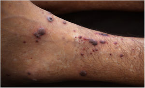 Púrpuras palpáveis e vesículas necróticas na extremidade do membro inferior esquerdo.