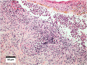 Exame histopatológico da pele evidenciando intenso infiltrado inflamatório difuso na derme, extravasamento de hemácias, paredes vasculares infiltradas por neutrófilos e necrose fibrinoide. Vesícula subepidérmica, preenchida por hemácias e neutrófilos (Hematoxilina & eosina, 10×).
