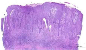 Exame anatomopatológico: cordões epiteliais anastomosantes de células cuboides formando trabéculas em estroma fibroso que partem da epiderme à derme profunda (Hematoxilina & eosina, 20×).