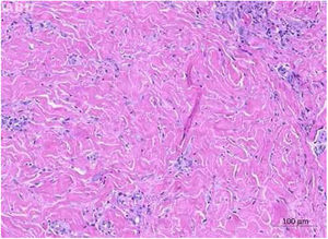 Exame anatomopatológico: estroma fibroso na derme média e profunda (Hematoxilina & eosina, 100×).