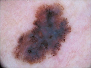 Melanoma extensivo superficial com Breslow 0,5mm; localizado na região cervical. À dermatoscopia, observa‐se assimetria de contorno, cores e estruturas, rede atípica, pontos e glóbulos atípicos, estrias radiadas e pseudópodes e véu azul‐esbranquiçado, caracterizando padrão multicomponentes.