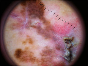 Melanoma extensivo superficial com Breslow 0,6mm localizado na perna. À dermatoscopia, observa‐se assimetria, rede atípica, pontos e glóbulos atípicos, estruturas de regressão, vasos atípicos e área vermelho‐leitoso, caracterizando padrão multicomponentes.