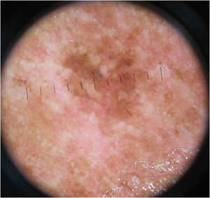 Melanoma extensivo superficial in situ localizado na região cervical, em paciente com melanomas múltiplos. À dermatoscopia, observa‐se assimetria e variação de cores, entretanto sem estruturas específicas, caracterizando padrão inespecífico.