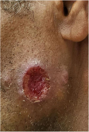 Leishmaniose tegumentar americana. Úlcera na face, com borda eritematosa, infiltrada, e fundo granuloso, em agricultor do vale do rio Tietê.
