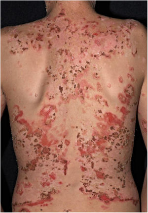 Pênfigo foliáceo (fogo selvagem). Extensas exulcerações com crostas hemáticas no dorso, em jovem morador do vale do rio Tietê.
