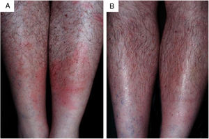 Erythema chronicum migrans (A), como manifestação precoce da borreliose‐símile. Remissão do quadro (B), após tratamento com doxiciclina. (Cortesia do Prof. Sinésio Talhari.).