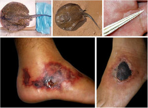 Arraias fluviais (Potamotrygon sp.) associadas a acidentes graves com banhistas e pescadores na bacia do rio Paraná. Detalhe do ferrão serrilhado. Lesões cutâneas por acidentes com arraia: úlceras nos membros inferiores com extensa base livedoide (< 72 horas) que evoluem com necrose e escara (> 7 dias).