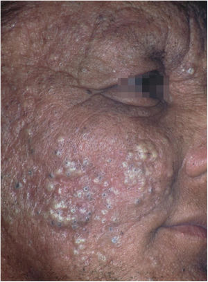 Cloracne. Agricultor do vale do rio Tietê com erupção papulopustulosa extensa com comedões. Refere manuseio desprotegido de defensivo agrícola contendo hexaclorobenzeno (banido do Brasil na década de 1980). Houve comprometimento de três outros membros da família.