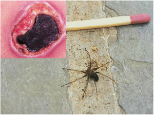Úlcera cutânea com formação de escara necrótica em área de acidente loxoscélico (> 96 horas). Exemplar de animal adulto da “aranha marrom” (Loxosceles sp.).