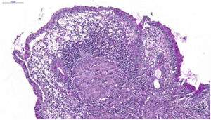 Granulomas não caseosos em mucosa ileal (Hematoxilina & eosina, 10×).