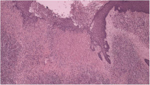 Histopatologia com fibroplasia, vasos neoformados associados a infiltrado linfocítico inflamatório com exsudato de neutrófilos (Hematoxilina & eosina, 40×).