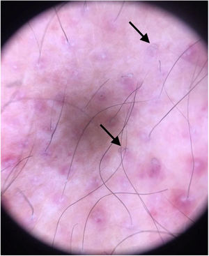 Dermatoscopia: pelos em saca‐rolha.