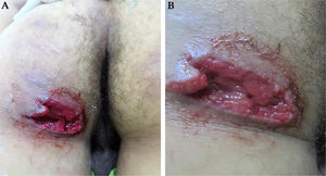 (A e B), Úlcera profunda com bordas irregulares e bem definidas, perfurante, eritema perilesional leve, fundo limpo, granular, sem exsudação, no glúteo esquerdo.