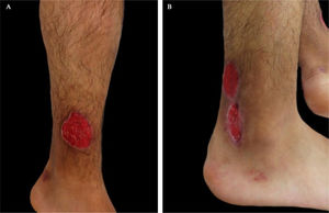 (A e B), Úlceras superficiais, de formato arredondado, bem definidas, bordas elevadas e de coloração violácea em ambas as pernas.
