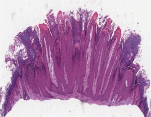Verruga vulgar apresentando hiperceratose, papilomatose, acantose e cones epiteliais com eixo em direção ao centro da lesão (Hematoxilina & eosina, 40×).