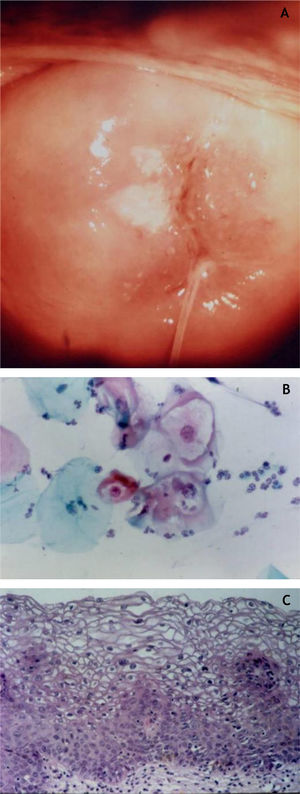 (A), Colposcopia; (B), Citopatologia oncótica; (C), Aspecto histopatológico do epitélio que mostra perda da estratificação e polimorfismo nuclear (Hematoxilina & eosina, 300×).