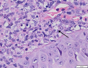 Anatomopatológico de úlcera plantar evidenciando infiltrado na derme e formas amastigotas de Leishmania braziliensis no interior de macrófagos (seta) (Hematoxilina & eosina, 100×).