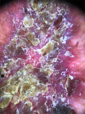 Dermatoscopia antes da remoção de crostas.