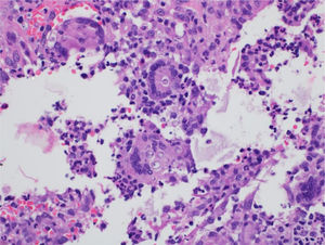 Paracoccidioidomicose e transplante hepático: detalhe do processo inflamatório onde se evidenciam células fúngicas no citoplasma de células gigantes (Hematoxilina & eosina, 100×).