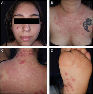 (A‐C) Pápulas, placas e nódulos eritematosos na face, tórax e região dorsal. (D) Pápulas eritematosas e pústulas na região plantar.