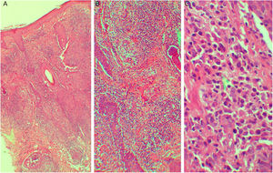 (A e B) Dermatite granulomatosa não tuberculoide superficial e profunda (A, Hematoxilina & eosina, 40×; B, Hematoxilina & eosina, 100×). (C) A ponta de seta mostra a presença de plasmócitos (Hematoxilina & eosina, 400×).