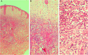 (A e B) Edema subepidérmico associado a infiltrado na derme superficial e média (A, Hematoxilina & eosina, 40×; B, Hematoxilina & eosina, 100×). (C) Infiltrado composto de neutrófilos polimorfonucleares (Hematoxilina & eosina, 400 ×).