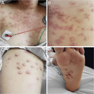 (A) Pápulas e placas no tórax com descamação e pústulas. (B) Pústulas no abdome associadas a eritema. (C) Grandes pústulas na coxa, com base eritematosa. (D) Crostas hemorrágicas na região plantar.