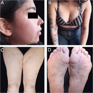 (A) Cicatrizes atróficas na face. (B‐D) Cicatrizes eritematosas de aspecto anetodérmico nos braços, coxas e pés.