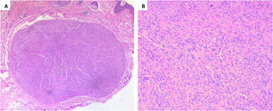 (A) Tumor encapsulado bem definido na derme (Hematoxilina & eosina, 100×). (B), Células de Schwann fusiformes formando corpúsculos de Verocay, padrão Anthony B (Hematoxilina & eosina, 200×).